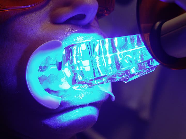 Ihr Leitfaden zur Zahnaufhellung